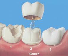 Dental crown