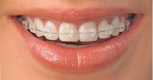 Dental braces